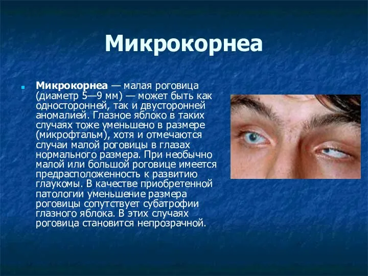 Микрокорнеа — малая роговица (диаметр 5—9 мм) — может быть как односторонней, так