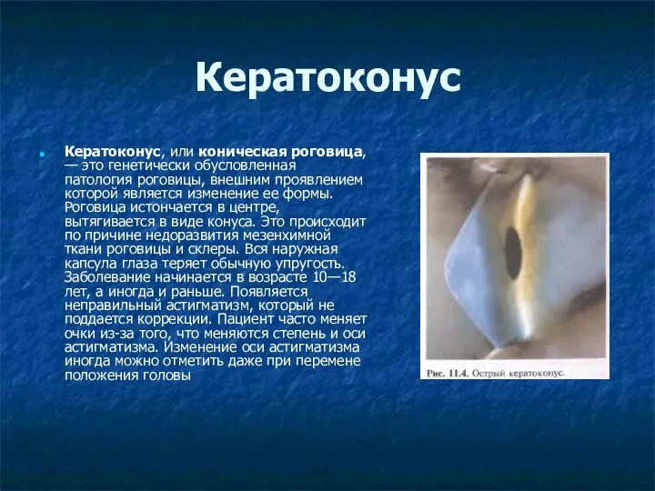 Кератоконус, или коническая роговица, — это генетически обусловленная патология роговицы, внешним проявлением которой