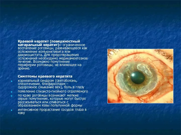 Краевой кератит (поверхностный катаральный кератит)– ограниченное воспаление роговицы, развивающееся как осложнение конъюнктивита или