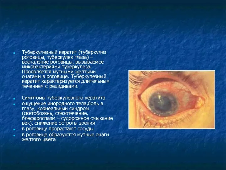 Туберкулезный кератит (туберкулез роговицы, туберкулез глаза) – воспаление роговицы, вызываемое микобактериями туберкулеза. Проявляется