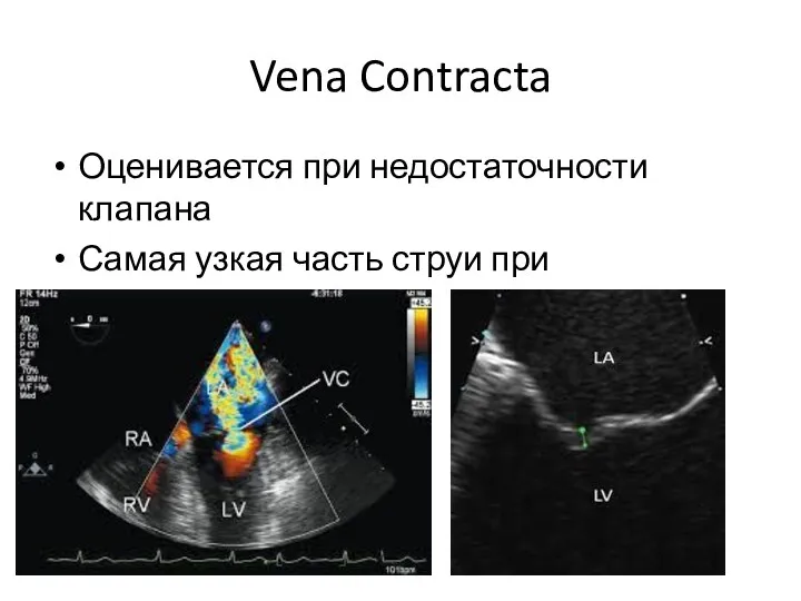 Vena Contracta Оценивается при недостаточности клапана Самая узкая часть струи при регургитации