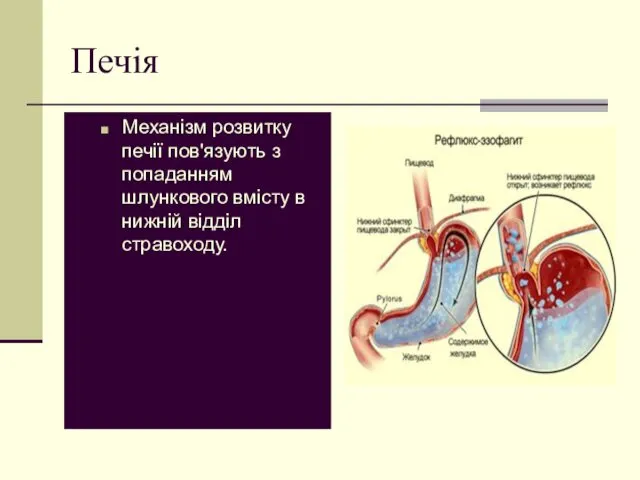 Печія Механізм розвитку печії пов'язують з попаданням шлункового вмісту в нижній відділ стравоходу.