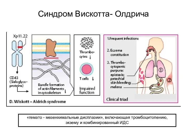 Синдром Вискотта- Олдрича «гемато - мезенхимальные дисплазии», включающая тромбоцитопению, экзему и комбинированный ИДС