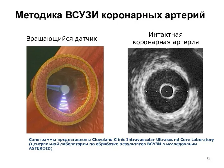 Методика ВСУЗИ коронарных артерий Вращающийся датчик Интактная коронарная артерия Сонограммы