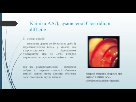 Клініка ААД, зумовленої Clostridium difficile легкий перебіг водяниста діарея до