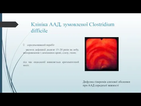 Клініка ААД, зумовленої Clostridium difficile Дифузна гіперемія слизової оболонки при