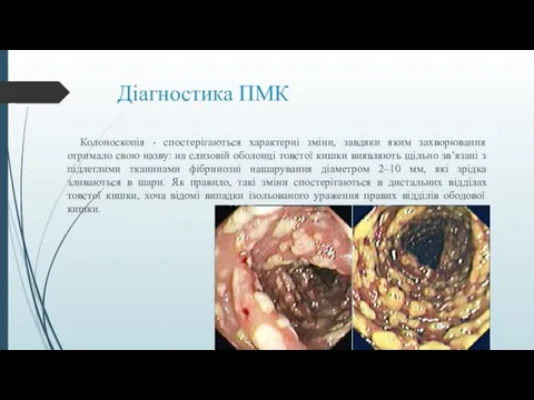 Діагностика ПМК Колоноскопія - спостерігаються характерні зміни, завдяки яким захворювання