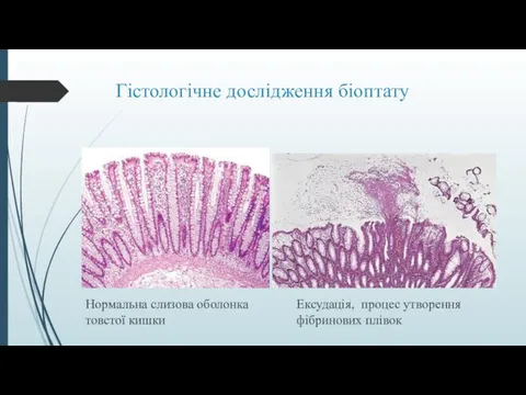 Гістологічне дослідження біоптату Нормальна слизова оболонка товстої кишки Ексудація, процес утворення фібринових плівок