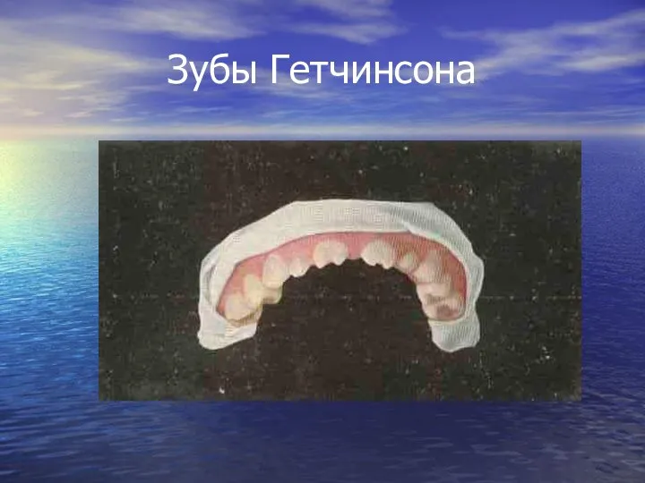 Зубы Гетчинсона