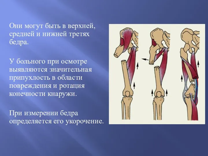 Они могут быть в верхней, средней и нижней третях бедра.