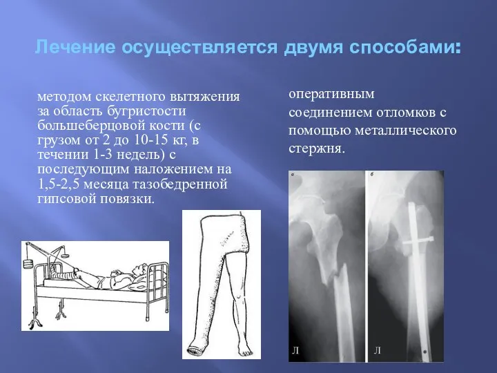 Лечение осуществляется двумя способами: методом скелетного вытяжения за область бугристости