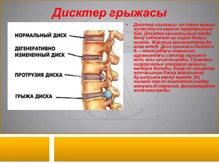 Дисктер грыжасы Дисктер грыжасы- ол тірек-қимыл жүйесінің ең қауіпті ауруларының