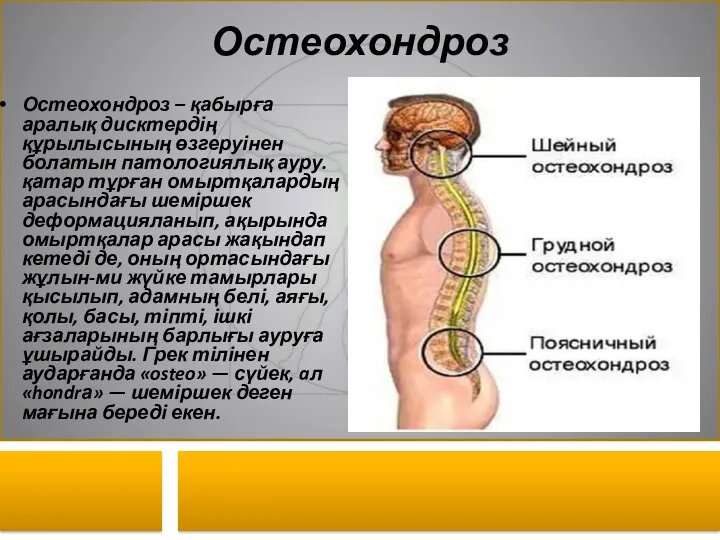 Остеохондроз Остеохондроз – қабырға аралық дисктердің құрылысының өзгеруінен болатын патологиялық