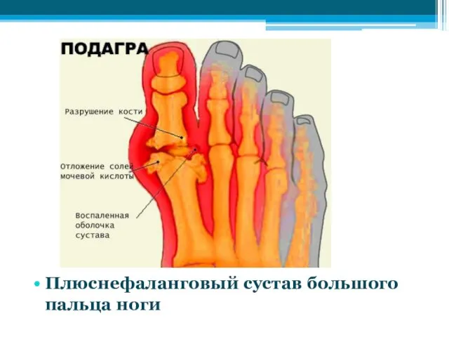 Плюснефаланговый сустав большого пальца ноги