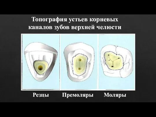 Резцы Премоляры Моляры Топография устьев корневых каналов зубов верхней челюсти