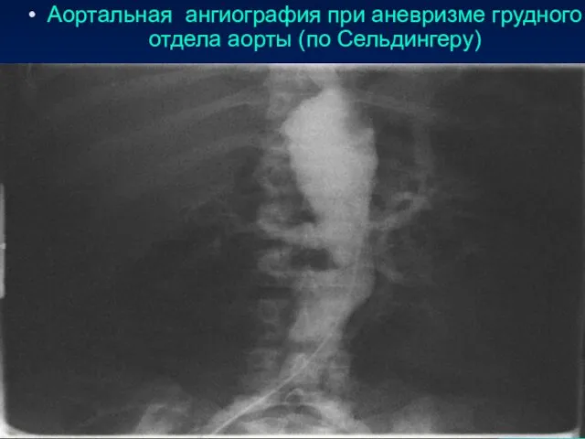 Аортальная ангиография при аневризме грудного отдела аорты (по Сельдингеру)