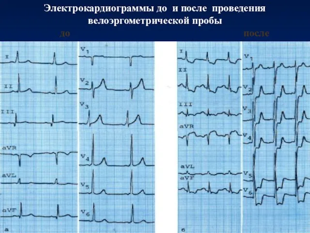 Электрокардиограммы до и после проведения велоэргометрической пробы до после