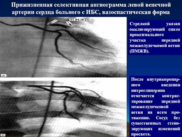 Прижизненная селективная ангиограмма левой венечной артерии сердца больного с ИБС, вазоспастическая форма Стрелкой