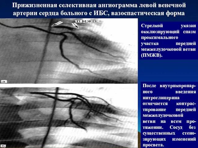 Прижизненная селективная ангиограмма левой венечной артерии сердца больного с ИБС,