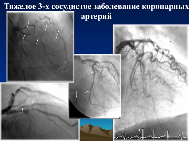 Тяжелое 3-х сосудистое заболевание коронарных артерий