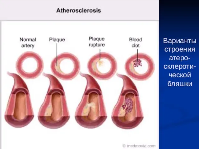 Варианты строения атеро-склероти-ческой бляшки