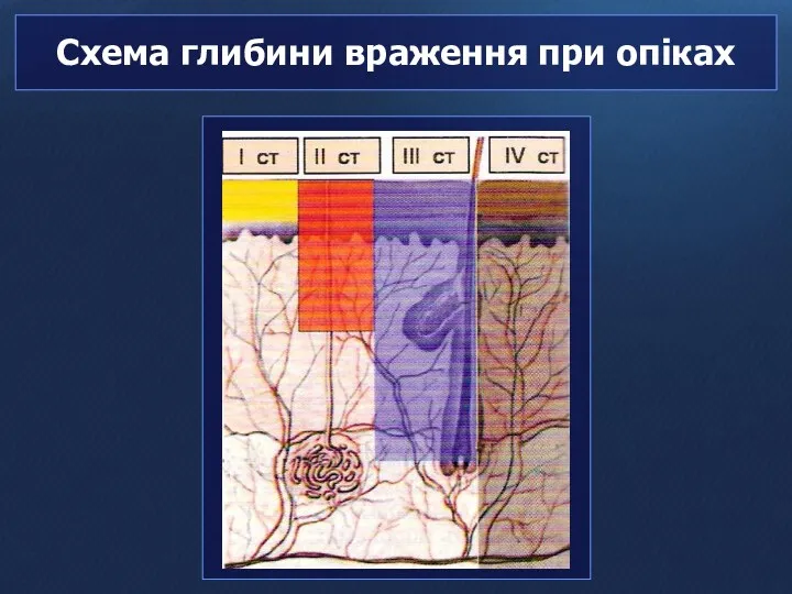 Схема глибини враження при опіках