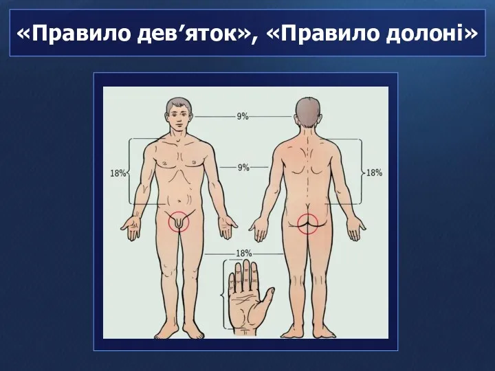 «Правило дев′яток», «Правило долоні»