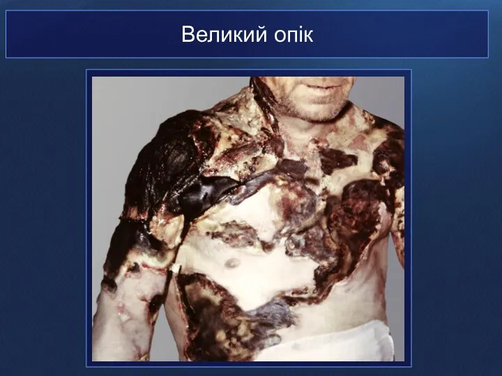 Великий опік