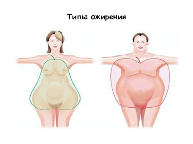 Типы ожирения