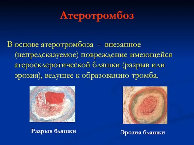 Атеротромбоз В основе атеротромбоза - внезапное (непредсказуемое) повреждение имеющейся атеросклеротической