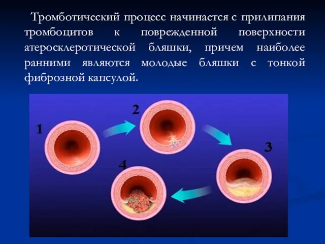 Тромботический процесс начинается с прилипания тромбоцитов к поврежденной поверхности атеросклеротической
