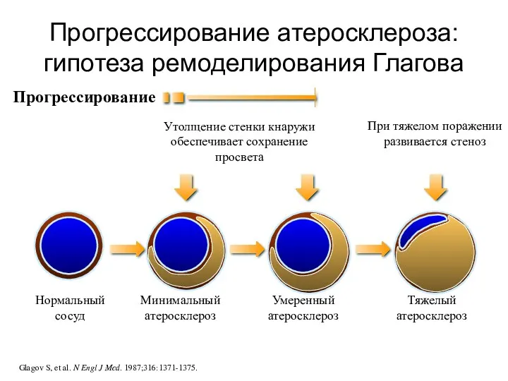 Прогрессирование атеросклероза: гипотеза ремоделирования Глагова Нормальный сосуд Прогрессирование Glagov S,