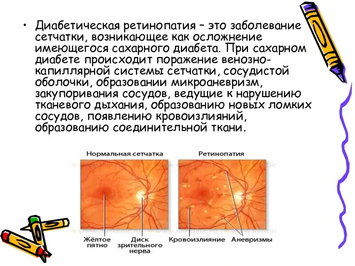 Диабетическая ретинопатия – это заболевание сетчатки, возникающее как осложнение имеющегося