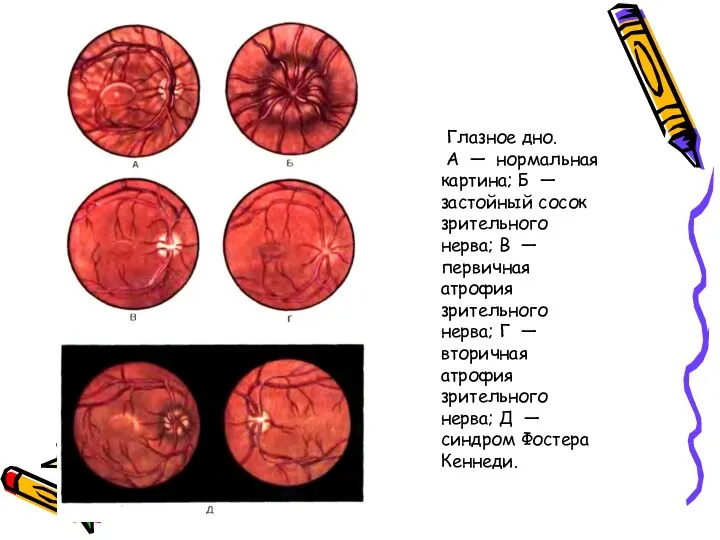 Глазное дно. А — нормальная картина; Б — застойный сосок