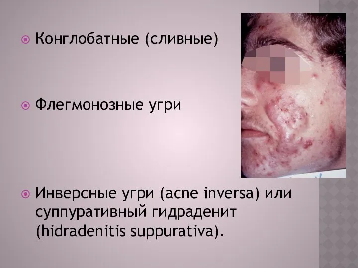 Конглобатные (сливные) Флегмонозные угри Инверсные угри (acne inversa) или суппуративный гидраденит (hidradenitis suppurativa).