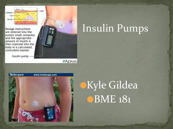 Insulin Pumps Kyle Gildea BME 181