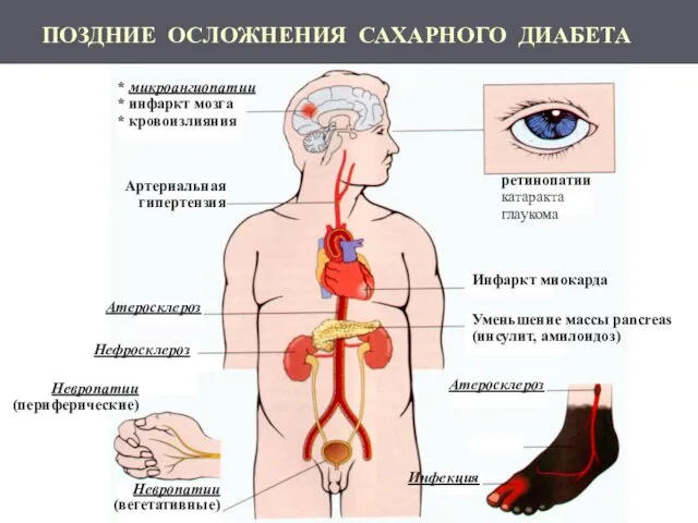 ПОЗДНИЕ ОСЛОЖНЕНИЯ САХАРНОГО ДИАБЕТА