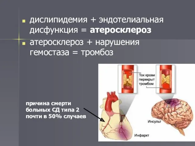 дислипидемия + эндотелиальная дисфункция = атеросклероз атеросклероз + нарушения гемостаза = тромбоз причина