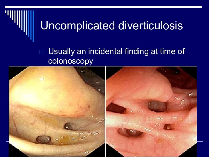 Uncomplicated diverticulosis Usually an incidental finding at time of colonoscopy