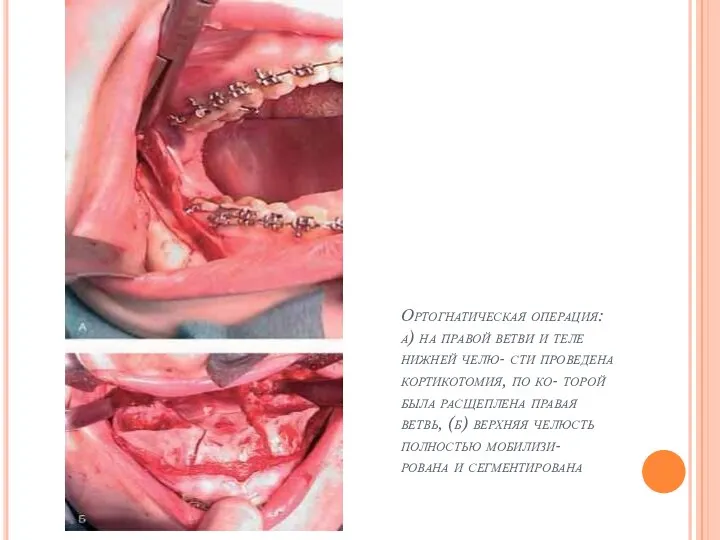 Ортогнатическая операция: а) на правой ветви и теле нижней челю- сти проведена кортикотомия,