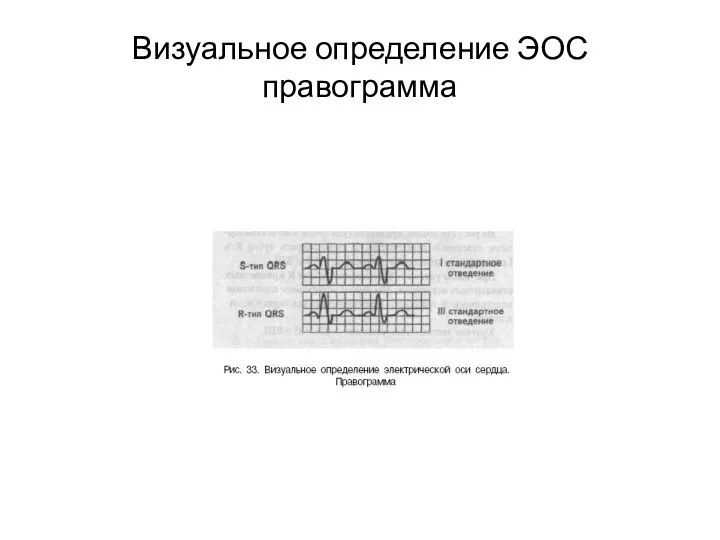 Визуальное определение ЭОС правограмма