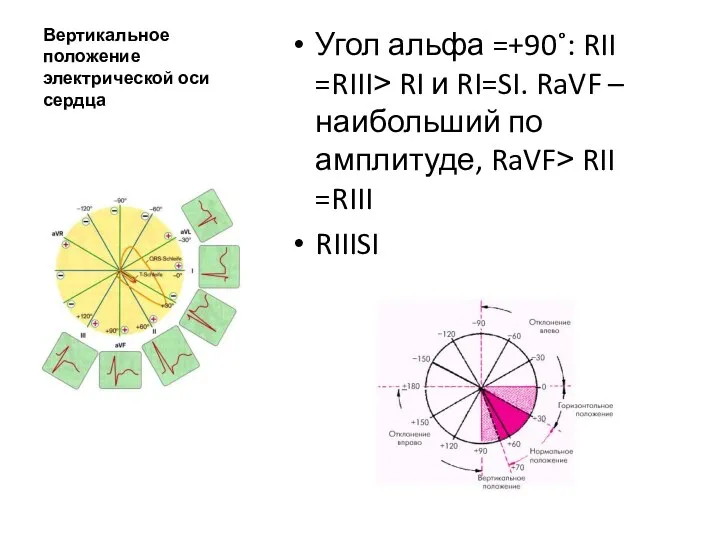 Вертикальное положение электрической оси сердца Угол альфа =+90˚: RII =RIII˃