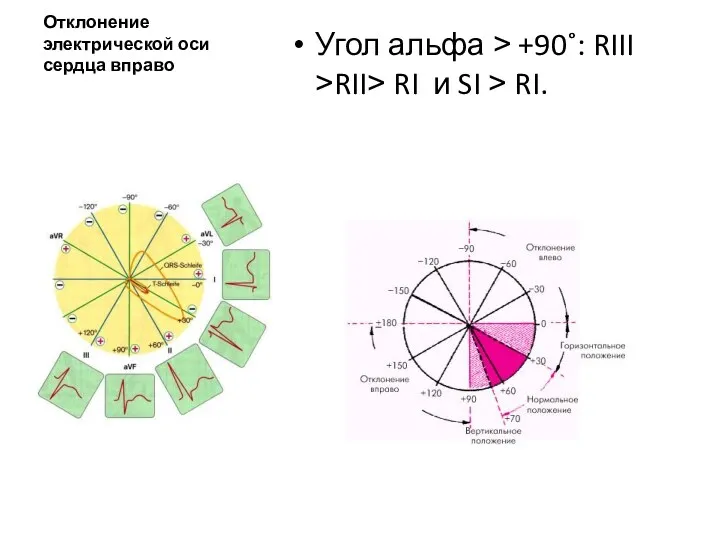 Отклонение электрической оси сердца вправо Угол альфа ˃ +90˚: RIII ˃RII˃ RI и SI ˃ RI.