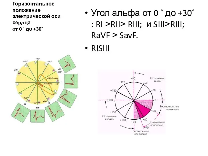 Горизонтальное положение электрической оси сердца от 0 ˚ до +30˚