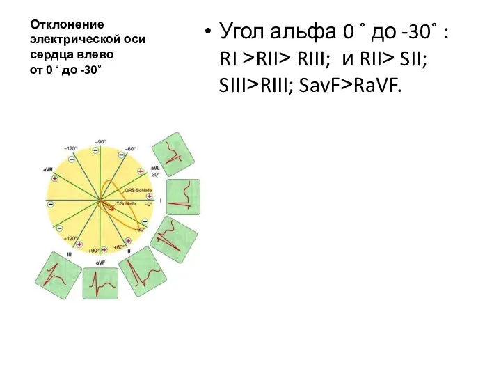 Отклонение электрической оси сердца влево от 0 ˚ до -30˚