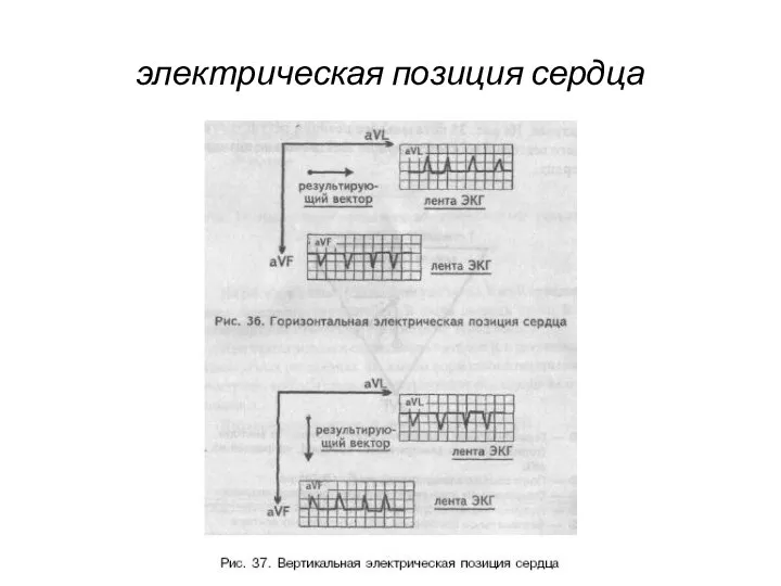 электрическая позиция сердца