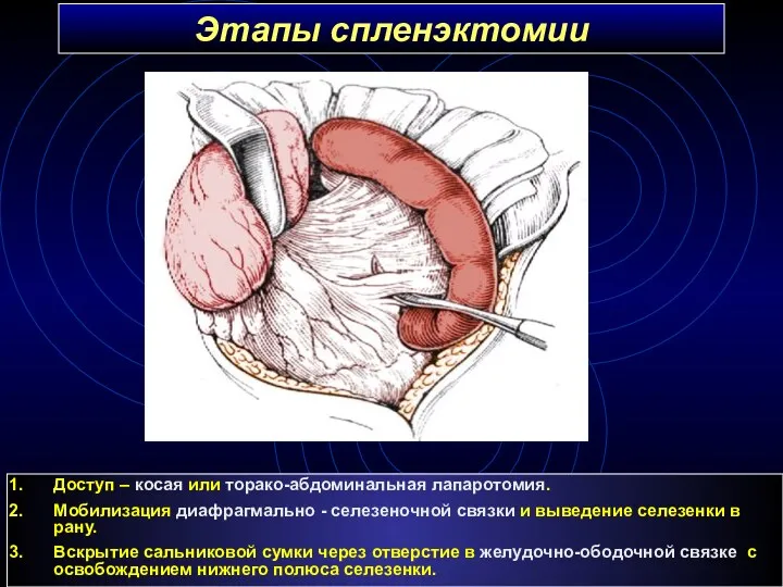 Этапы спленэктомии Доступ – косая или торако-абдоминальная лапаротомия. Мобилизация диафрагмально - селезеночной связки