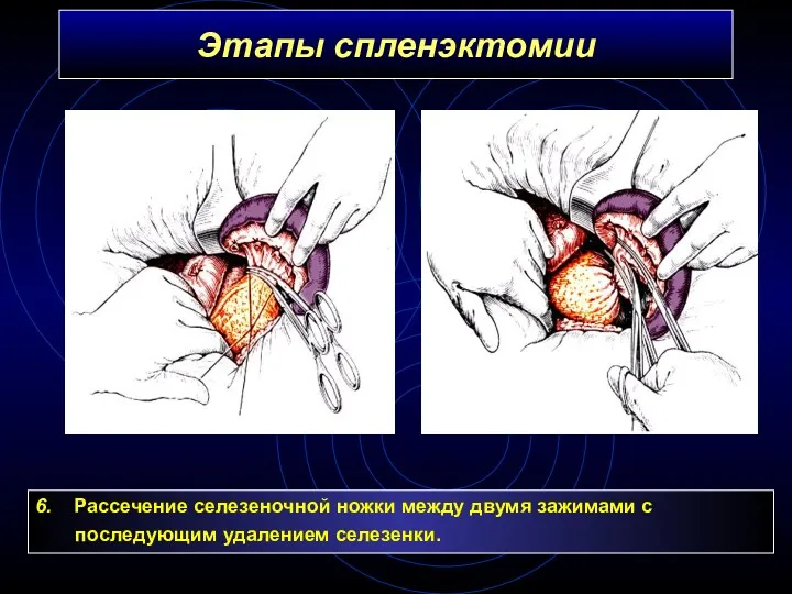 Этапы спленэктомии 6. Рассечение селезеночной ножки между двумя зажимами с последующим удалением селезенки.