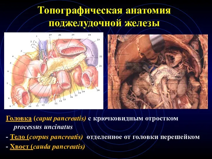Топографическая анатомия поджелудочной железы Головка (caput pancreatis) с крючковидным отростком processus uncinatus -