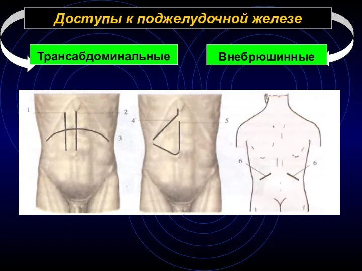 Доступы к поджелудочной железе Трансабдоминальные Внебрюшинные